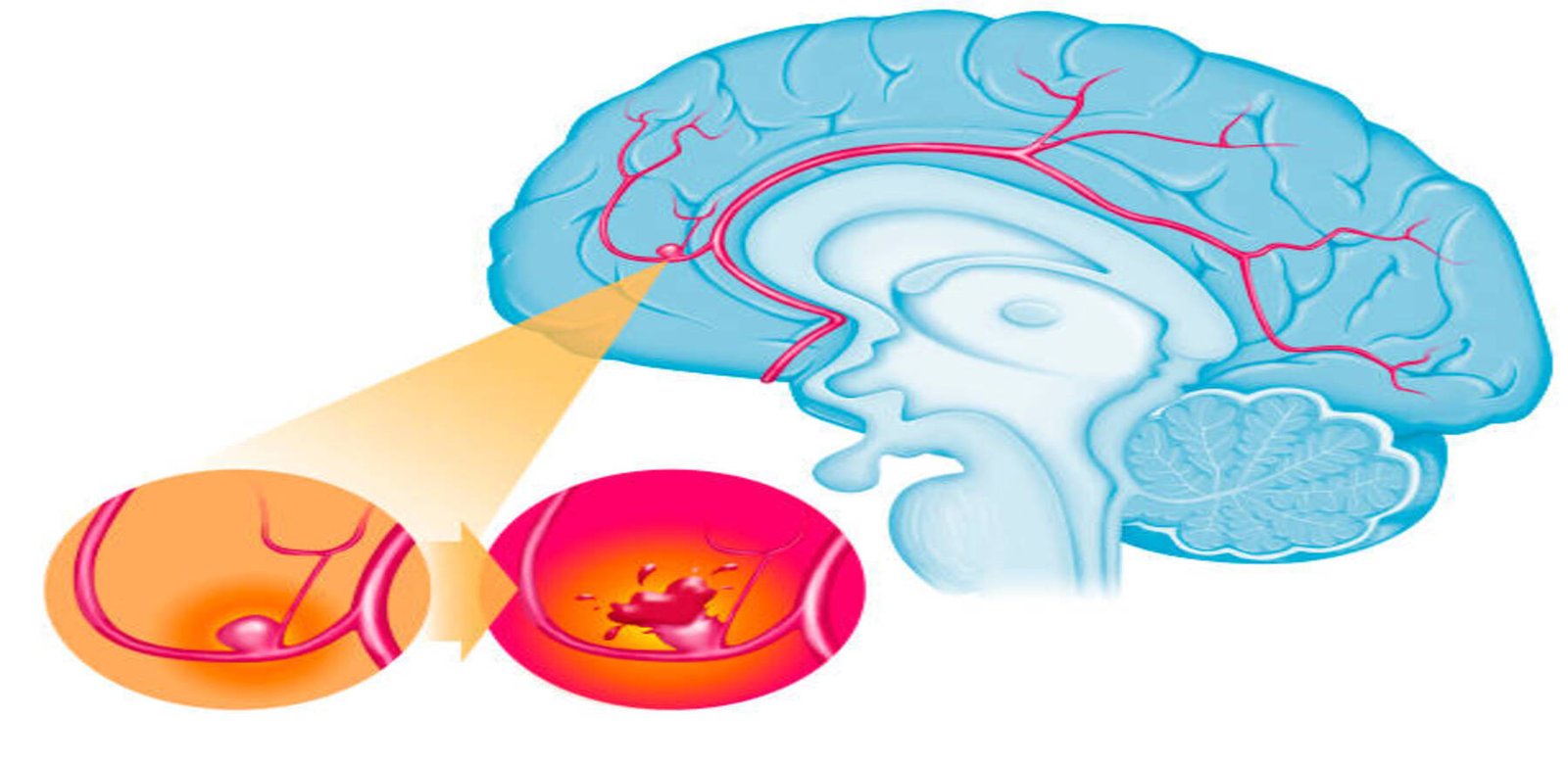 Neurology - brain-aneurysm-symptoms-treatment-dhule