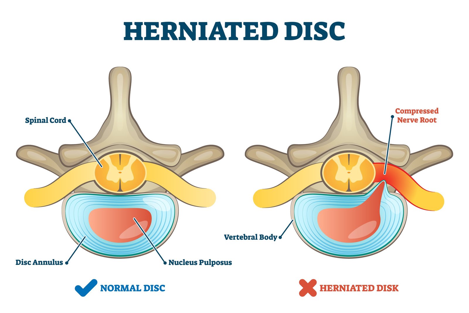 Dr Kapil Patil - Herniated Disc
